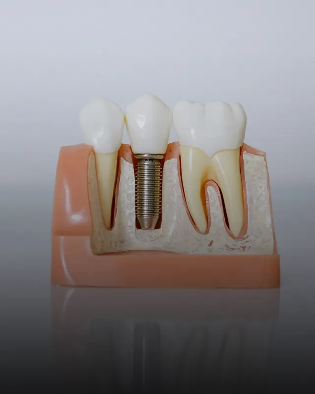 Dentist Brooklyn NY Implants BOX